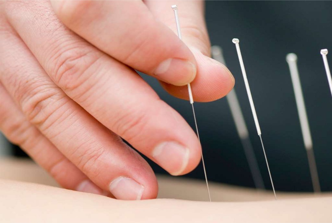 DRY NEEDLING AGULHAMENTO SECO